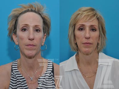 Austin Injectable Fillers Before & After Gallery - Patient 132963096 - Image 1 - The Piazza Center
