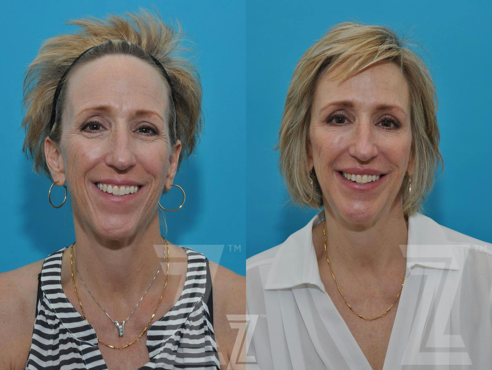 Injectable Fillers Before & After Gallery - Patient 132963096 - Image 2