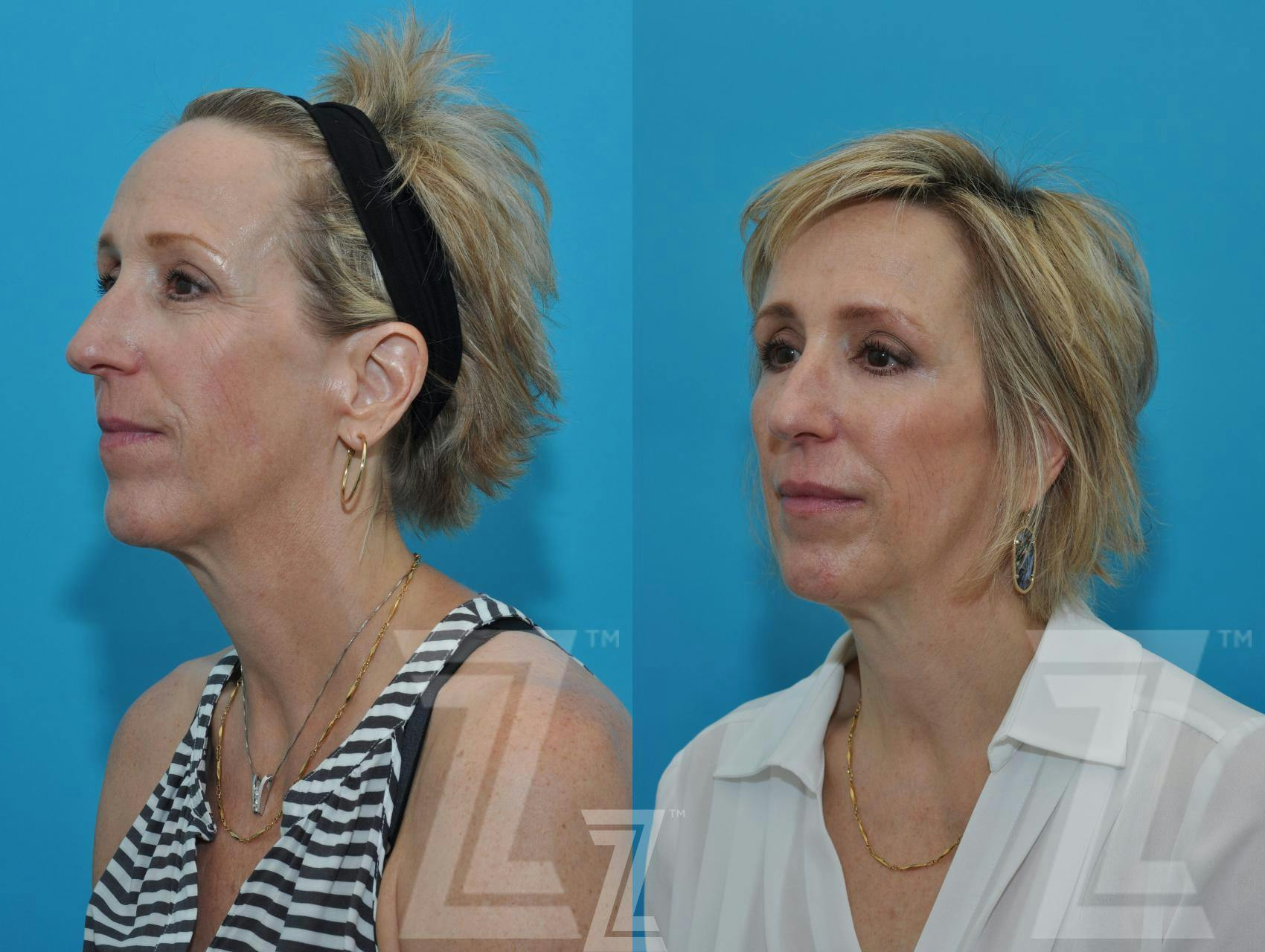 Injectable Fillers Before & After Gallery - Patient 132963096 - Image 3