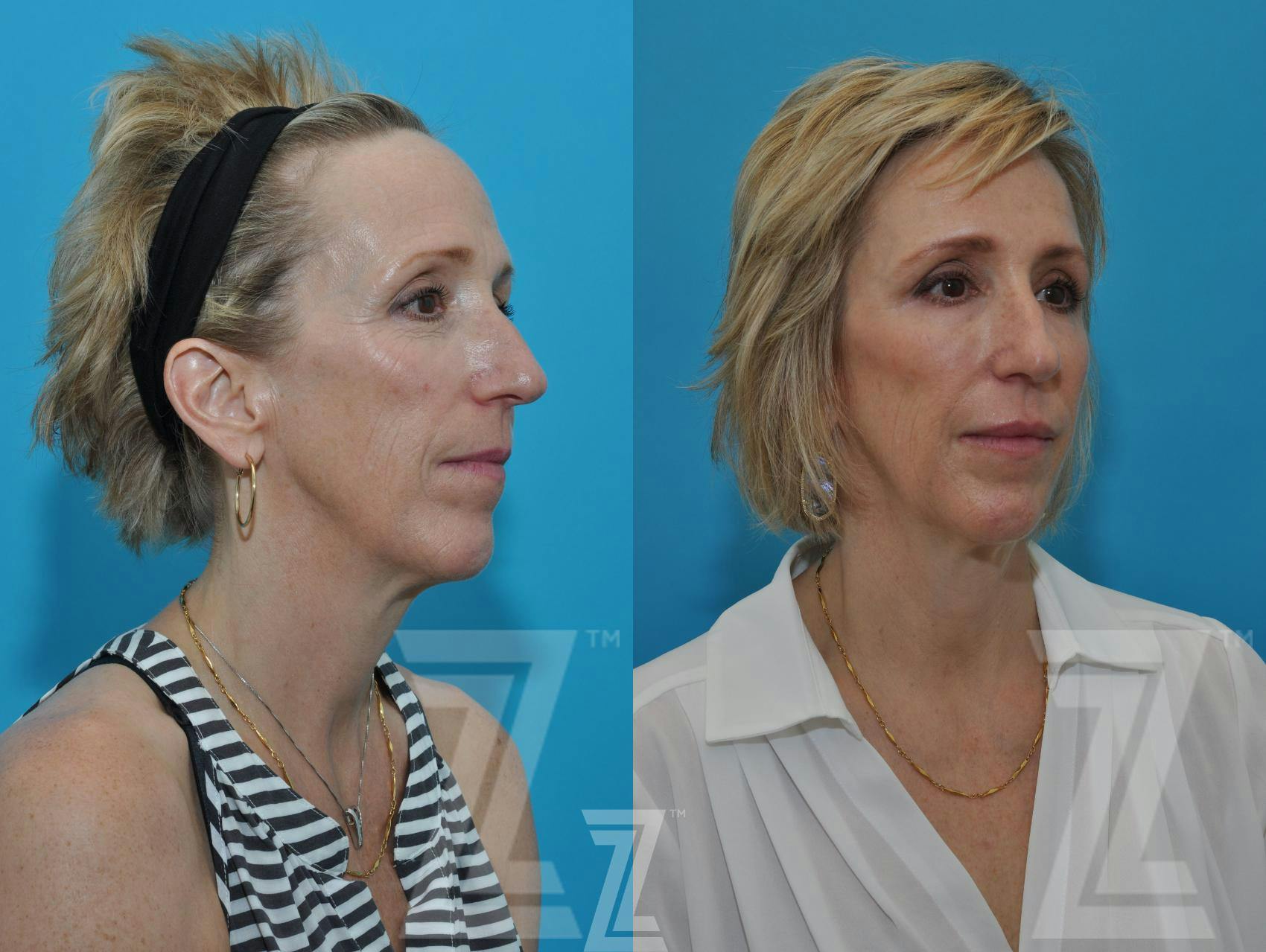 Injectable Fillers Before & After Gallery - Patient 132963096 - Image 4