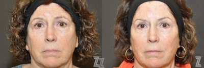 Facial Rejuvenation Before & After Gallery - Patient 150326 - Image 1