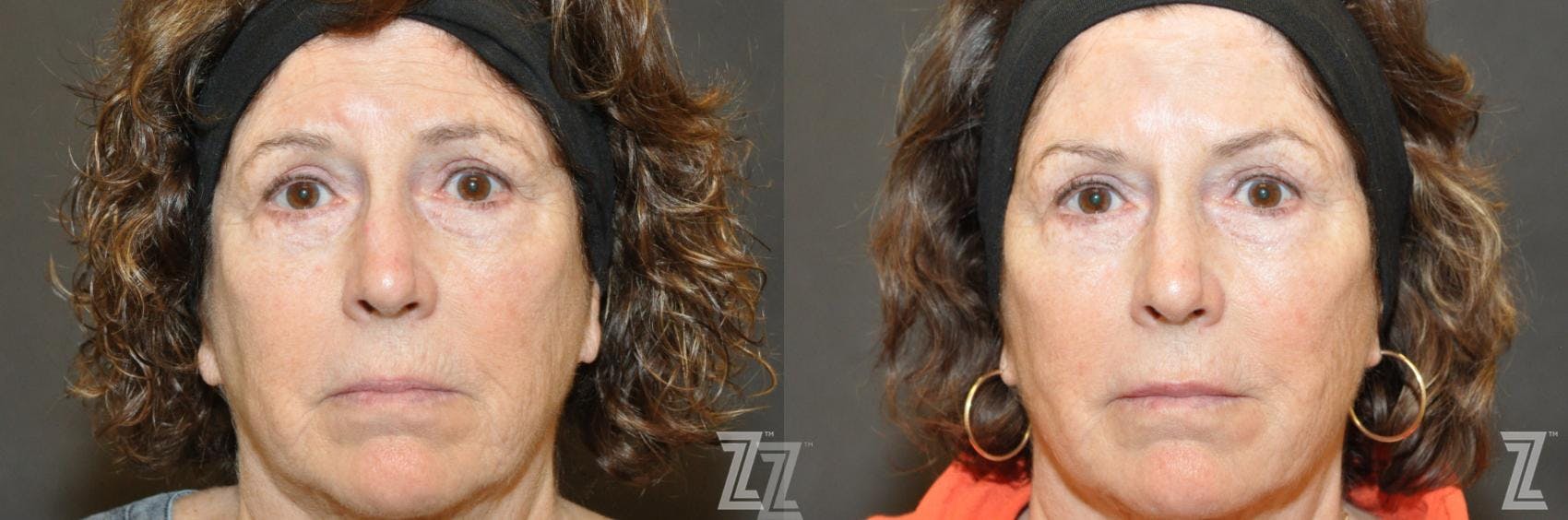 Facial Rejuvenation Before & After Gallery - Patient 150326 - Image 1