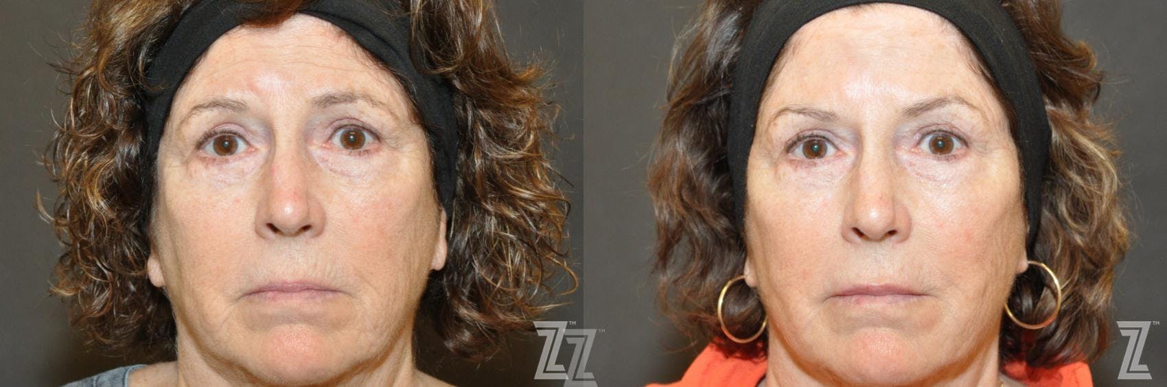 Injectable Fillers Before & After Gallery - Patient 132963098 - Image 1