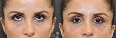 Injectable Fillers Before & After Gallery - Patient 132963099 - Image 1