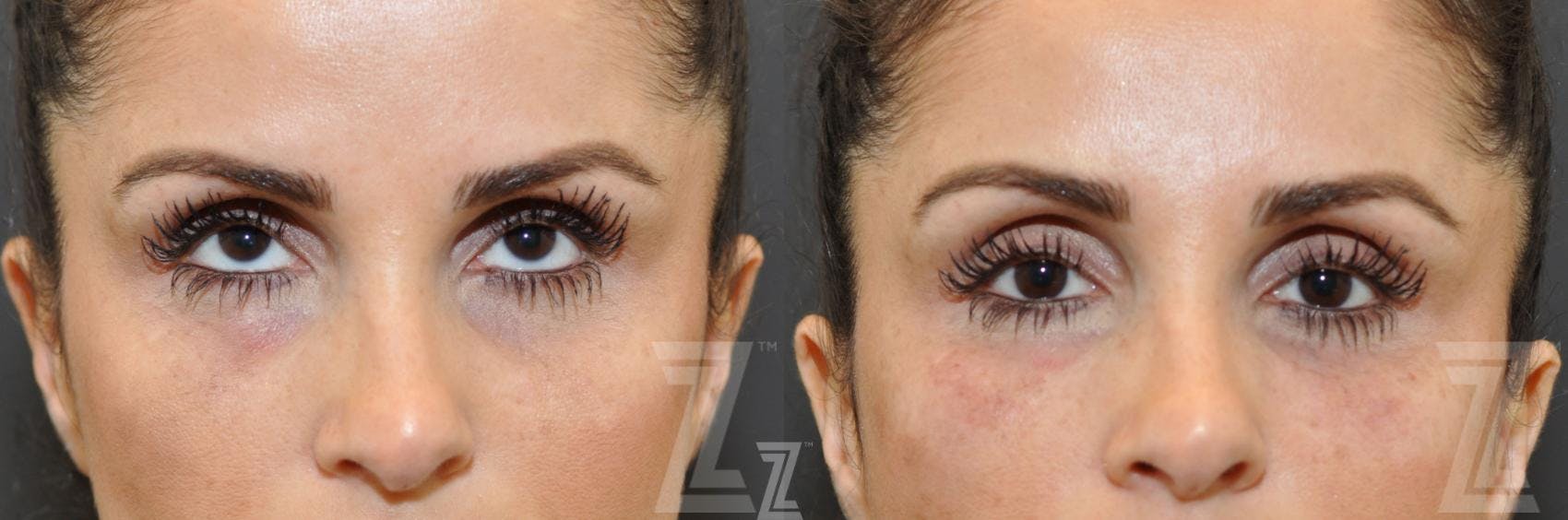 Injectable Fillers Before & After Gallery - Patient 132963099 - Image 1