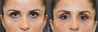 Austin Injectable Fillers Before & After Gallery - Patient 132963099 - Image 1 - The Piazza Center