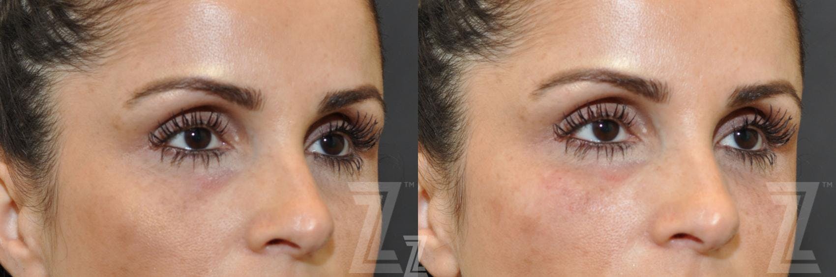 Injectable Fillers Before & After Gallery - Patient 132963099 - Image 2