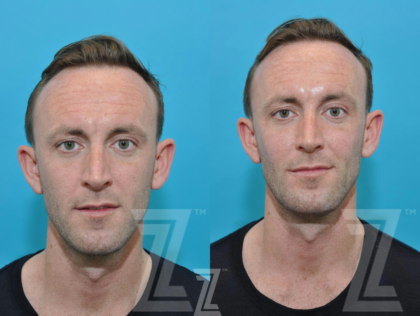 Austin Injectable Fillers Before & After Gallery - Patient 132963102 - Image 1 - The Piazza Center