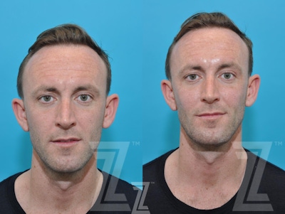Injectable Fillers Before & After Gallery - Patient 132963102 - Image 1
