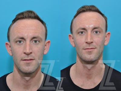 Austin Injectable Fillers Before & After Gallery - Patient 132963102 - Image 1 - The Piazza Center