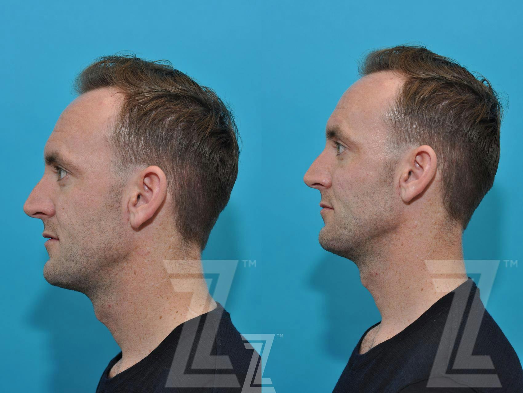 Injectable Fillers Before & After Gallery - Patient 132963102 - Image 2