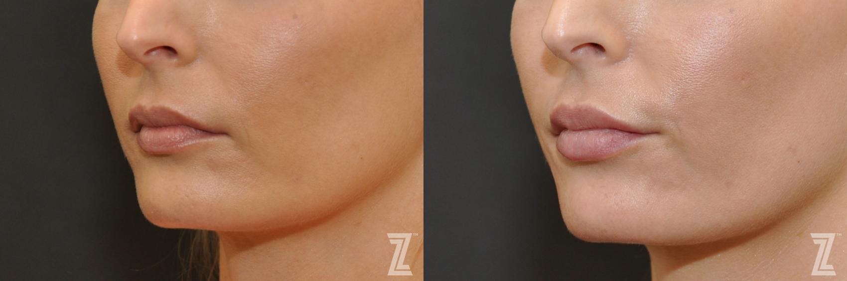 Injectable Fillers Before & After Gallery - Patient 132963103 - Image 1