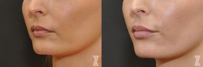 Austin Injectable Fillers Before & After Gallery - Patient 132963103 - Image 1 - The Piazza Center