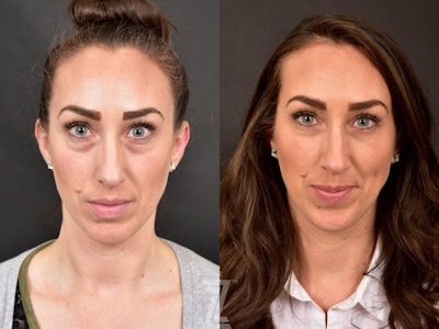 Injectable Fillers Before & After Gallery - Patient 132963104 - Image 1