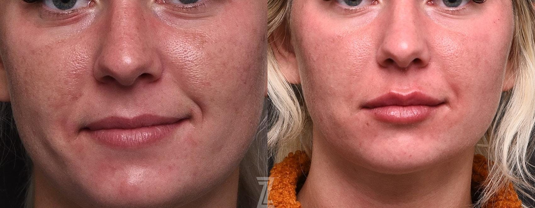 Injectable Fillers Before & After Gallery - Patient 132963106 - Image 1