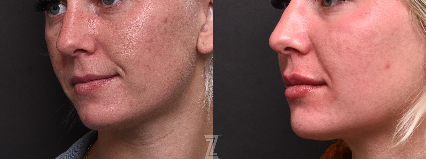 Injectable Fillers Before & After Gallery - Patient 132963106 - Image 2