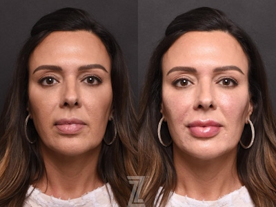 Injectable Fillers Before & After Gallery - Patient 132963109 - Image 1
