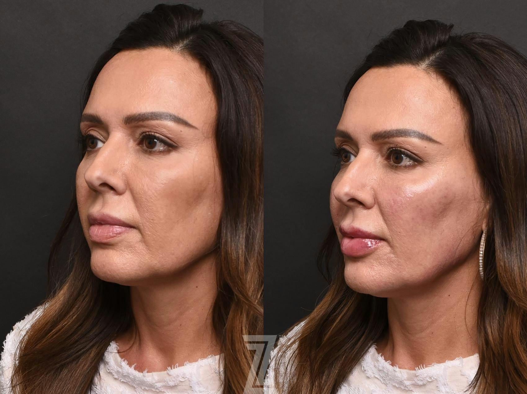 Injectable Fillers Before & After Gallery - Patient 132963109 - Image 2