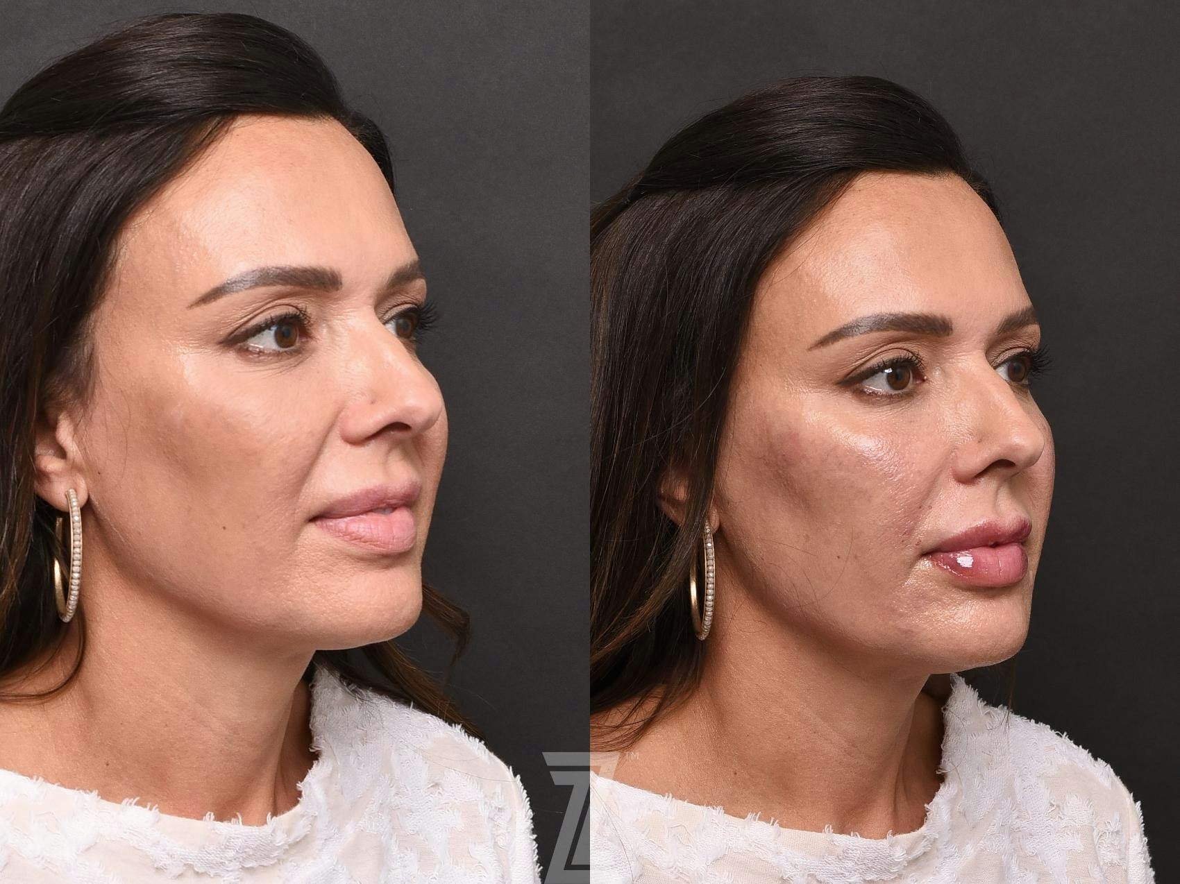 Injectable Fillers Before & After Gallery - Patient 132963109 - Image 3