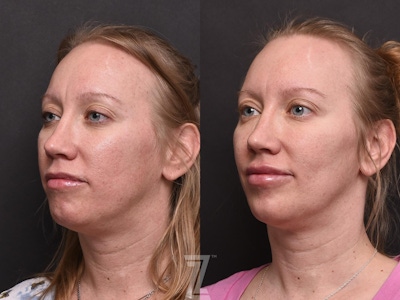 Facial Rejuvenation Before & After Gallery - Patient 118982 - Image 1