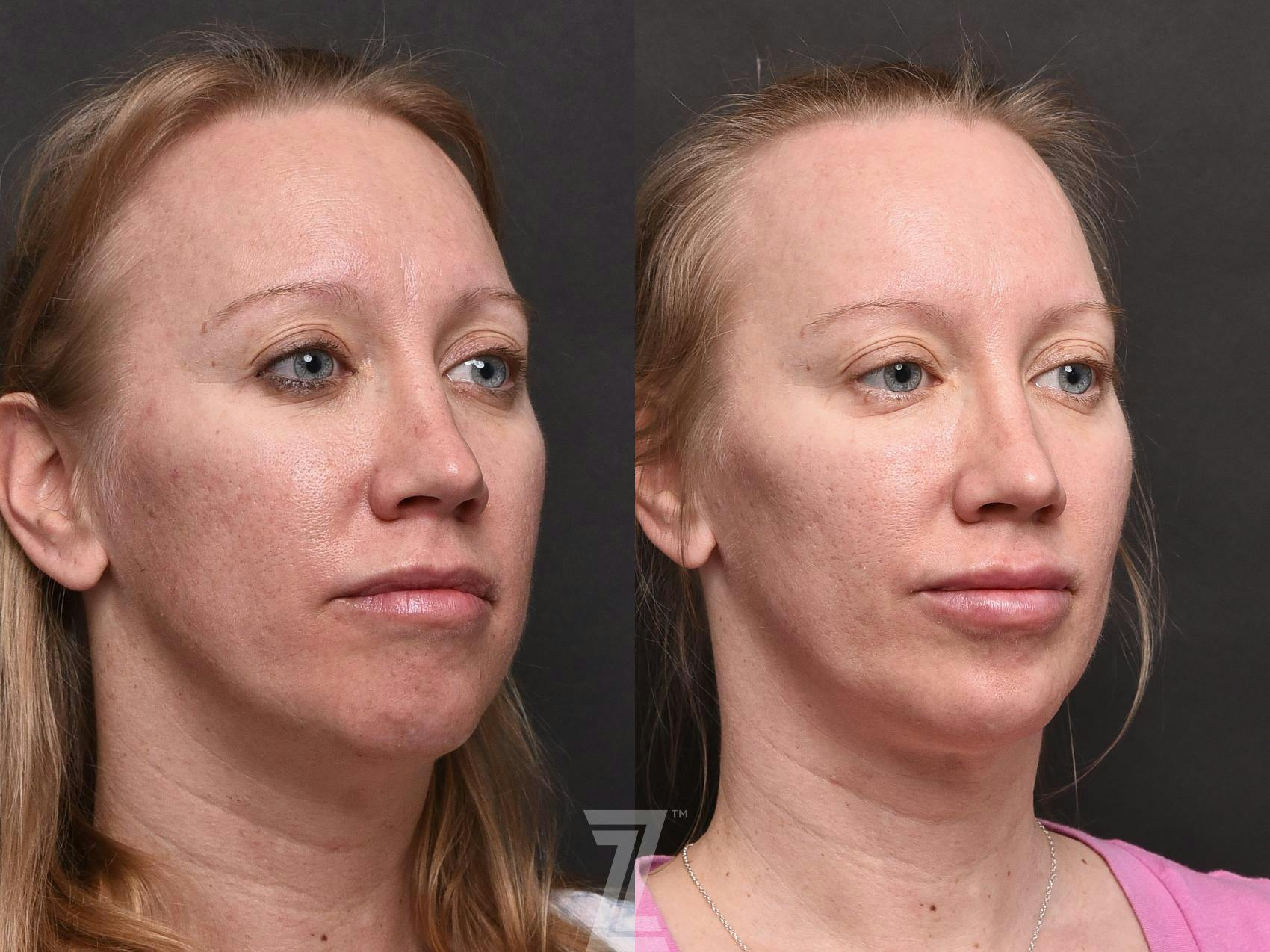 Facial Rejuvenation Before & After Gallery - Patient 118982 - Image 2