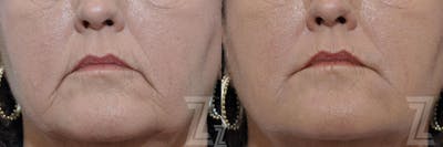 Austin Injectable Fillers Before & After Gallery - Patient 132963113 - Image 1 - The Piazza Center