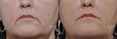 Injectable Fillers Before & After Gallery - Patient 132963113 - Image 1