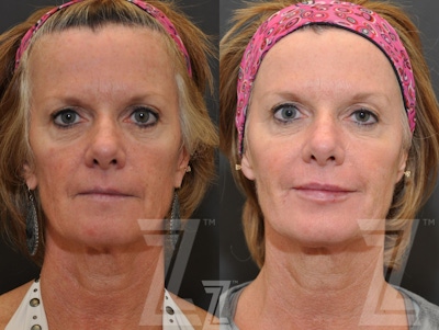 Injectable Fillers Before & After Gallery - Patient 132963114 - Image 1