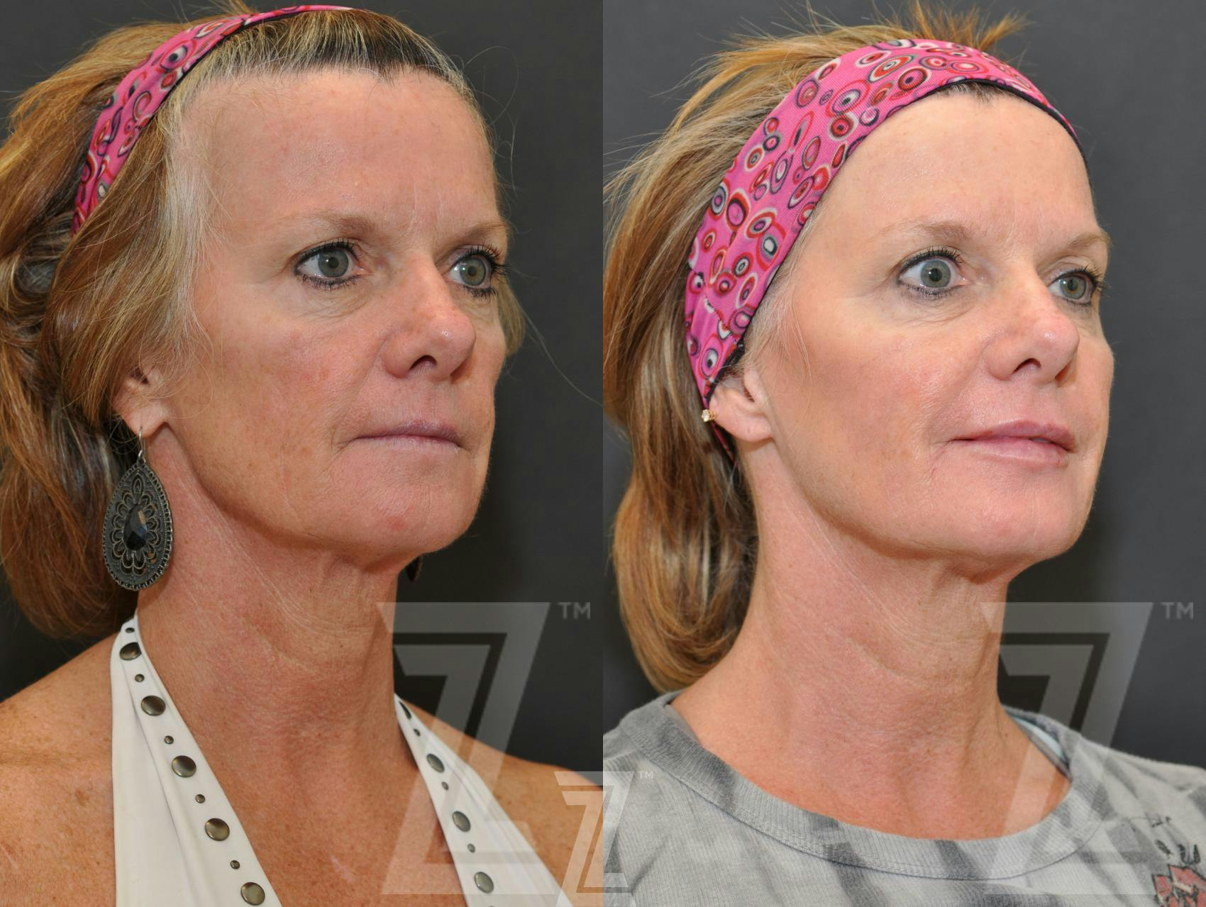 Injectable Fillers Before & After Gallery - Patient 132963114 - Image 2