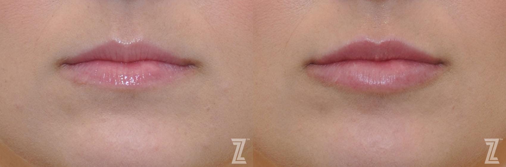 Injectable Fillers Before & After Gallery - Patient 132963115 - Image 1