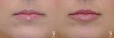 Austin Injectable Fillers Before & After Gallery - Patient 132963115 - Image 1 - The Piazza Center