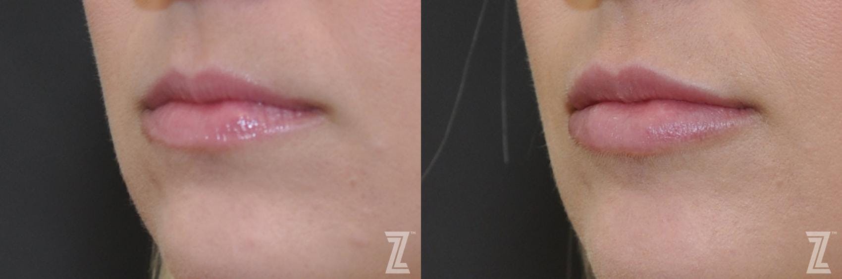 Injectable Fillers Before & After Gallery - Patient 132963115 - Image 2
