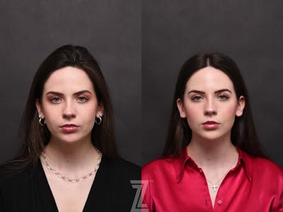 Austin Injectable Fillers Before & After Gallery - Patient 132963119 - Image 1 - The Piazza Center