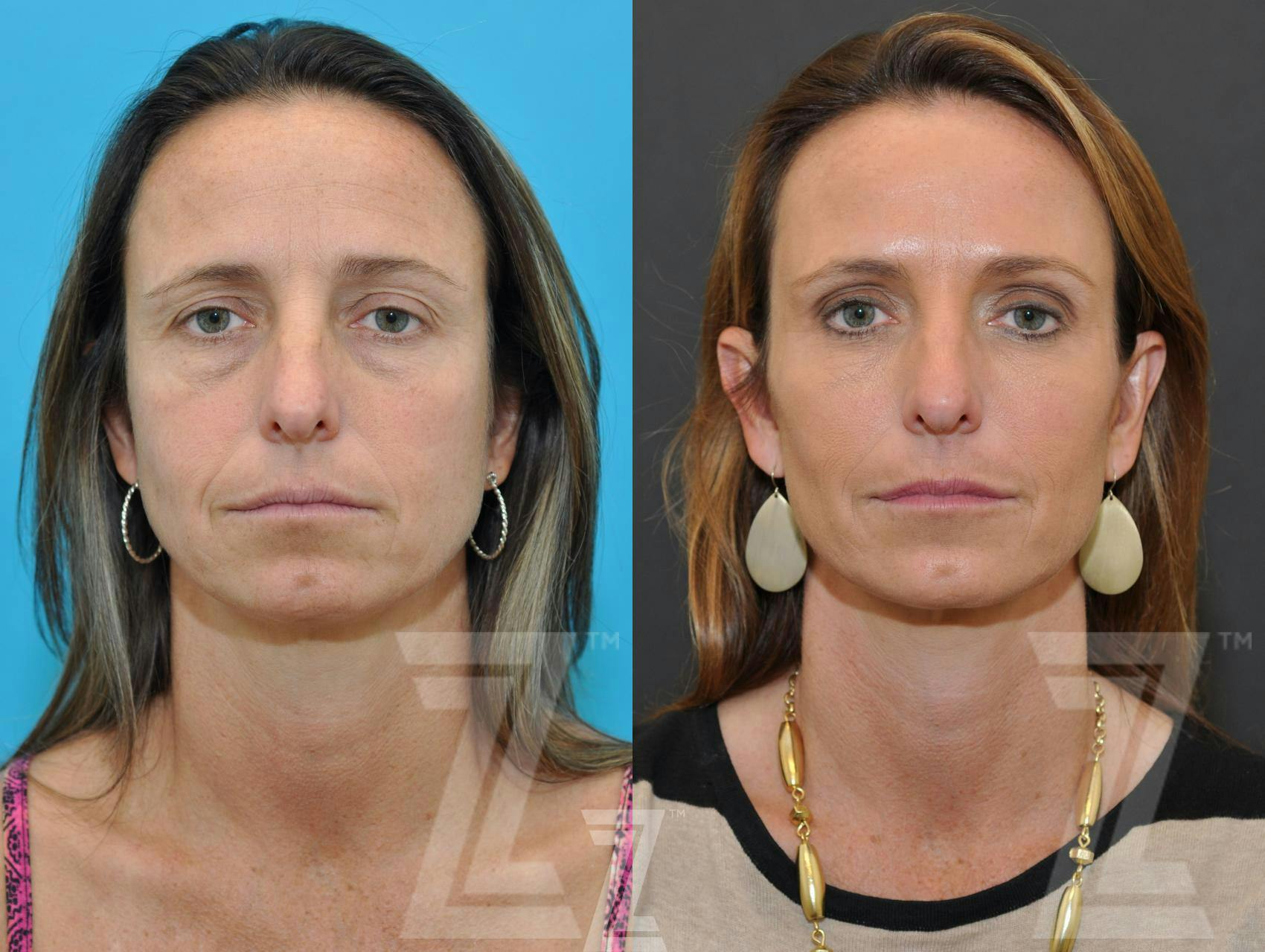 Injectable Fillers Before & After Gallery - Patient 132963121 - Image 1