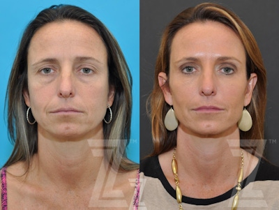 Facial Rejuvenation Before & After Gallery - Patient 326782 - Image 1