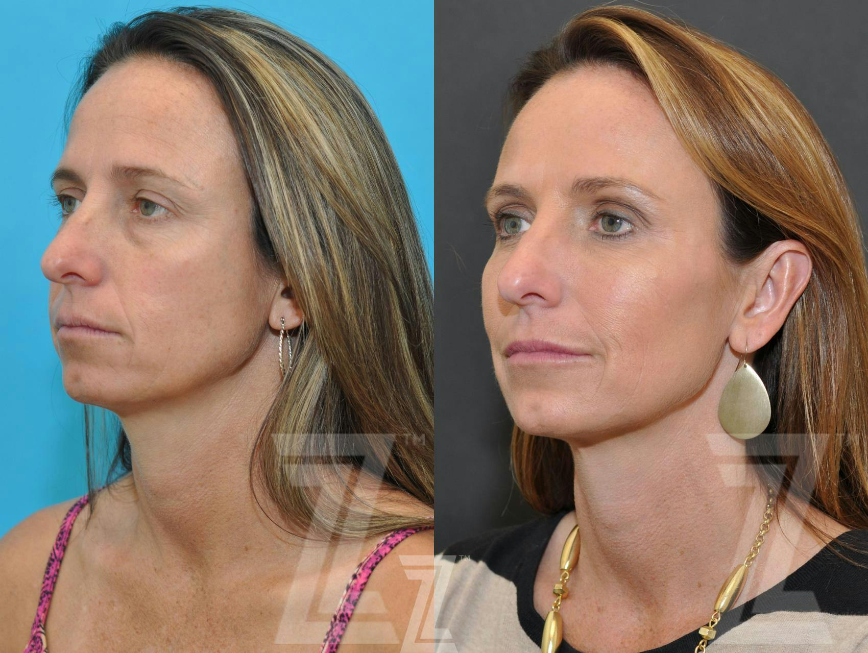 Facial Rejuvenation Before & After Gallery - Patient 326782 - Image 2
