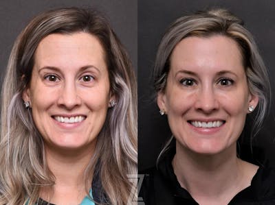 Austin Injectable Fillers Before & After Gallery - Patient 132963122 - Image 1 - The Piazza Center