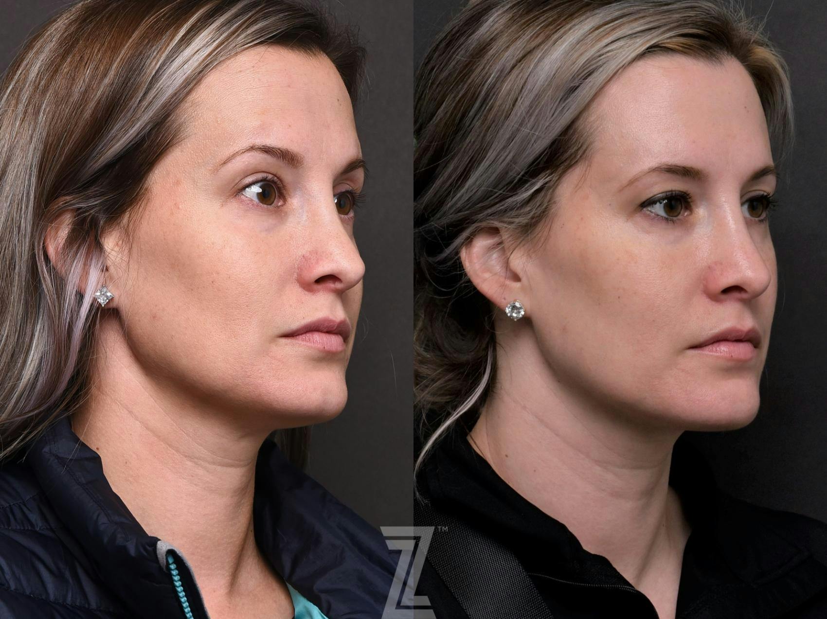 Injectable Fillers Before & After Gallery - Patient 132963122 - Image 2