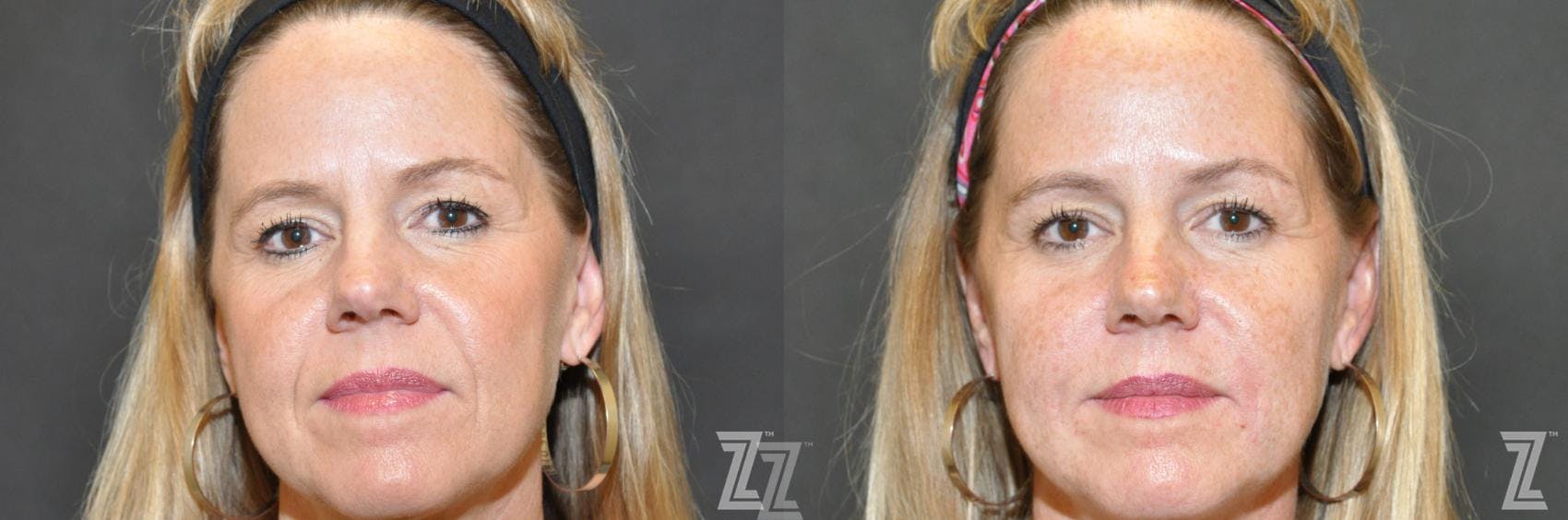 Injectable Fillers Before & After Gallery - Patient 132963124 - Image 1