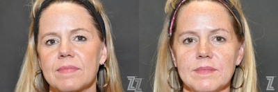 Facial Rejuvenation Before & After Gallery - Patient 186050 - Image 1