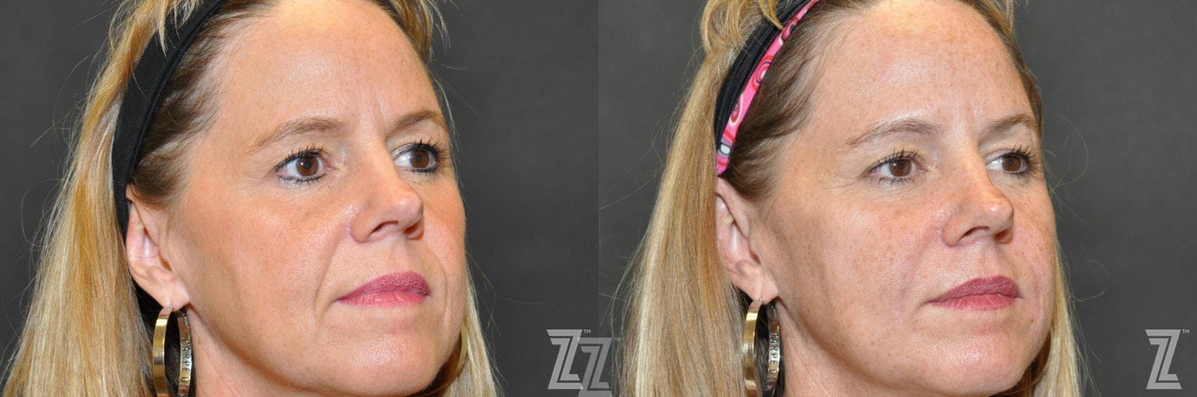 Facial Rejuvenation Before & After Gallery - Patient 186050 - Image 2