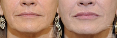 Injectable Fillers Before & After Gallery - Patient 132963127 - Image 1