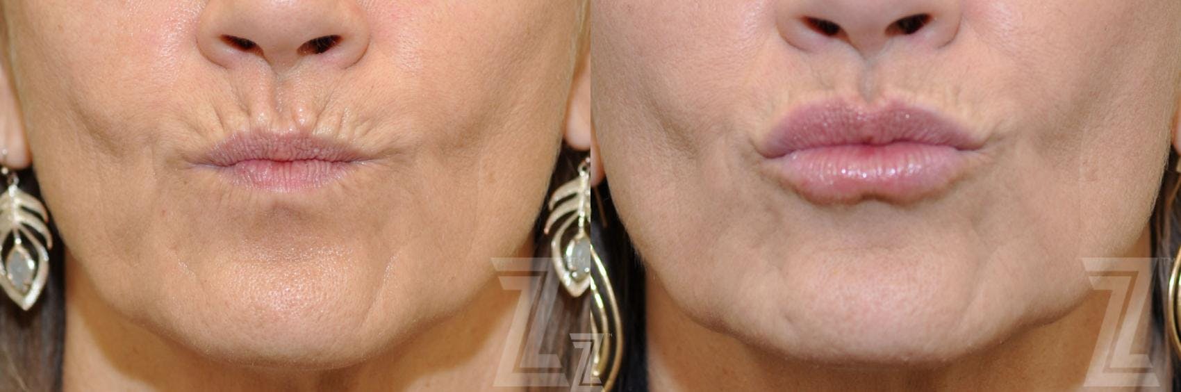 Injectable Fillers Before & After Gallery - Patient 132963127 - Image 2