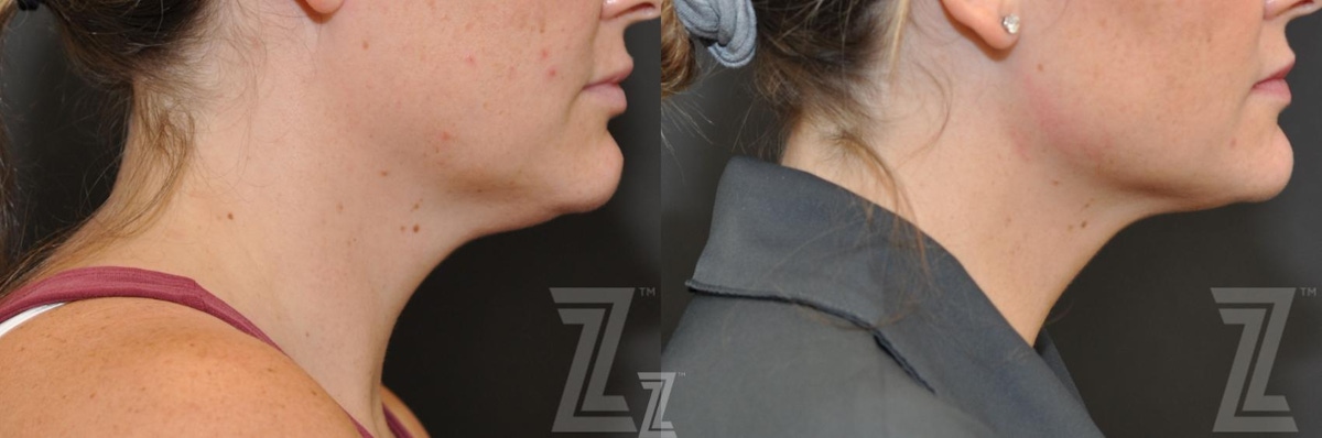 Austin KYBELLA® Before & After Gallery - Patient 132963129 - Image 1 - The Piazza Center