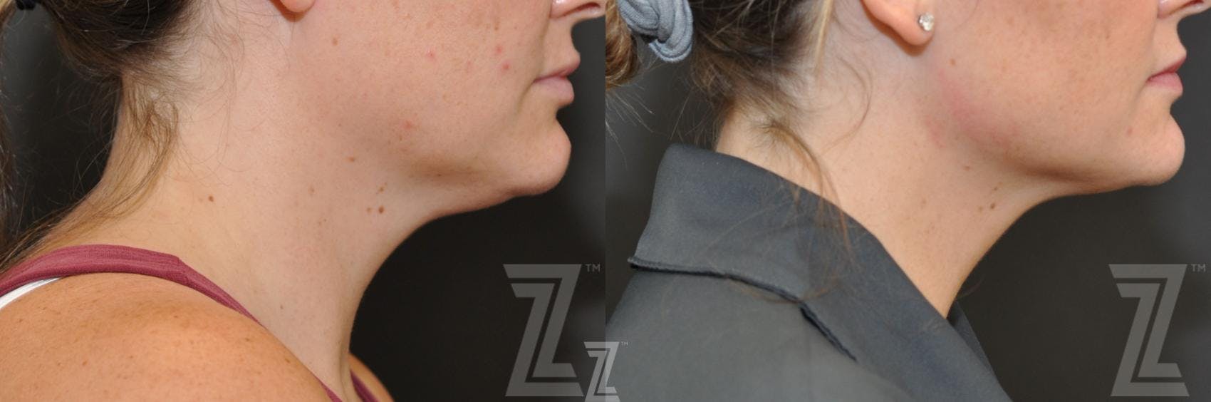 KYBELLA® Before & After Gallery - Patient 132963129 - Image 1