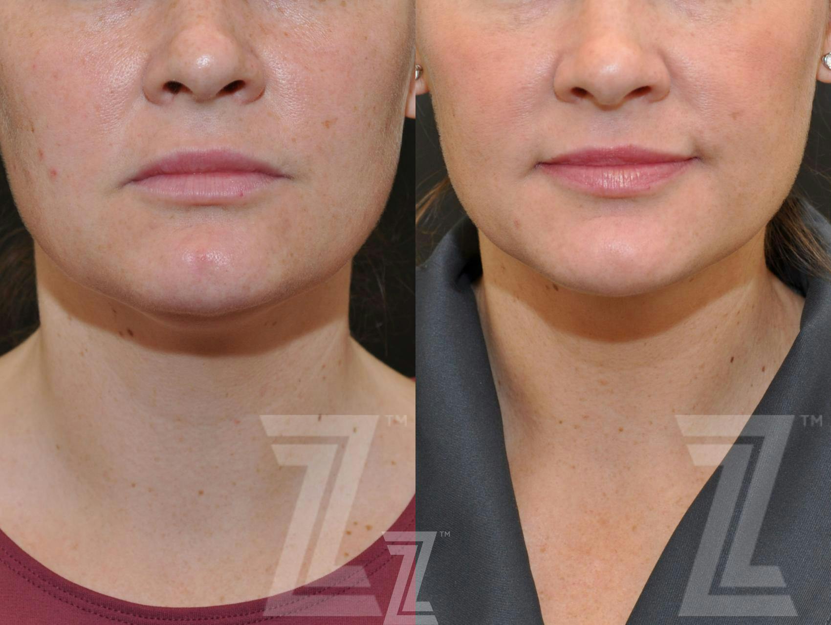 KYBELLA® Before & After Gallery - Patient 132963129 - Image 2