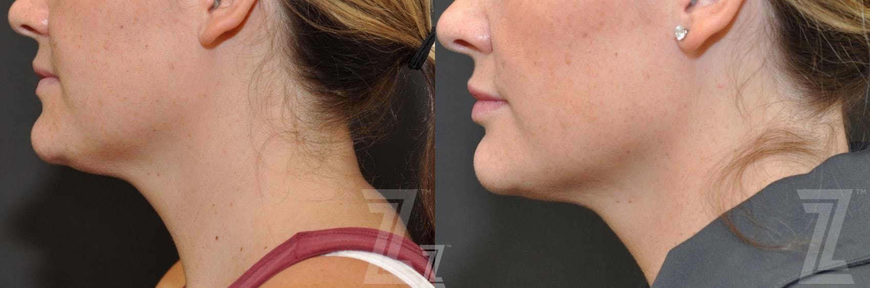 KYBELLA® Before & After Gallery - Patient 132963129 - Image 3