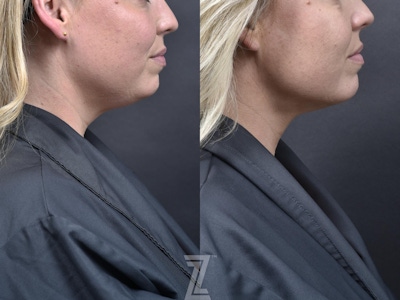KYBELLA® Before & After Gallery - Patient 132963130 - Image 1