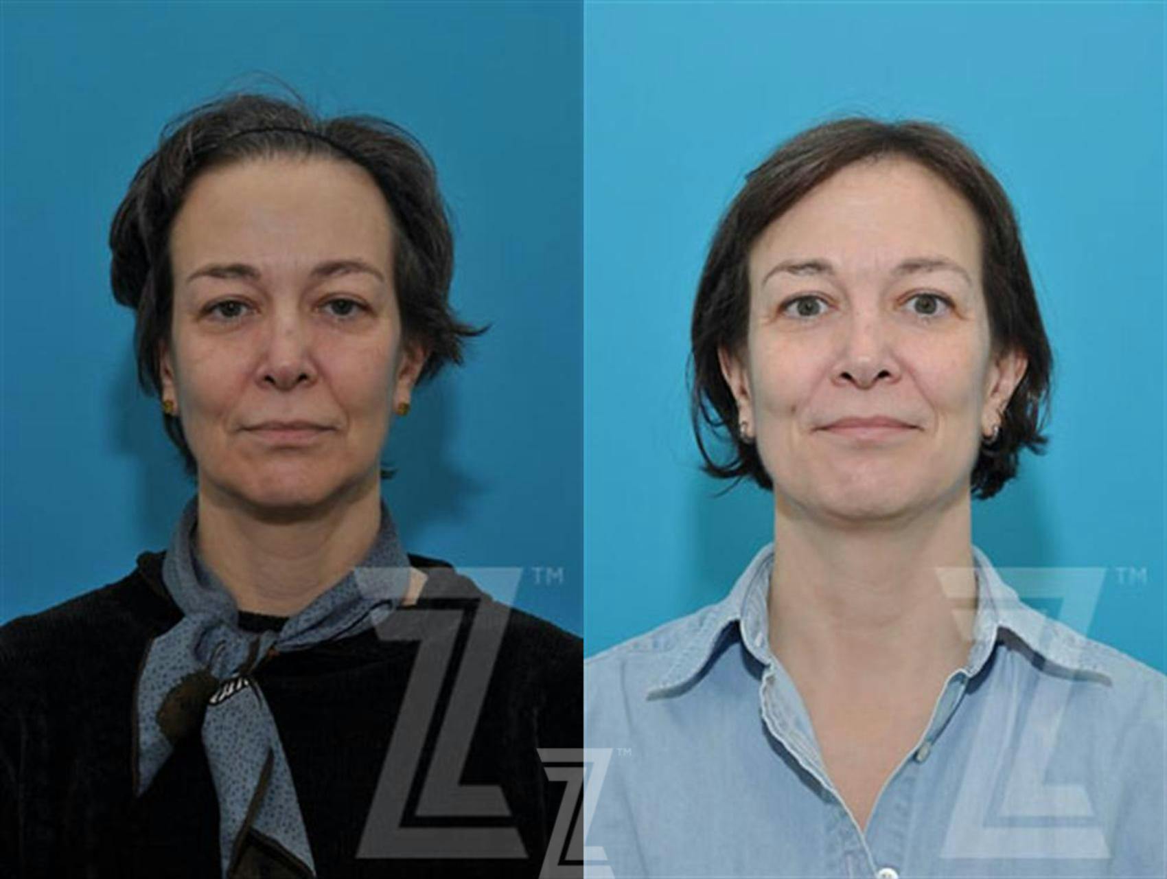 Sculptra® Before & After Gallery - Patient 132963131 - Image 1