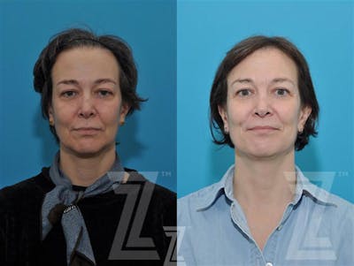 Austin Sculptra® Before & After Gallery - Patient 132963131 - Image 1 - The Piazza Center